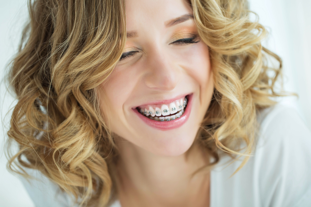 Metal Braces in Pleasanton